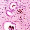 6A4 Aqueductal Gliosis (Case 6) 1 hemorrhage