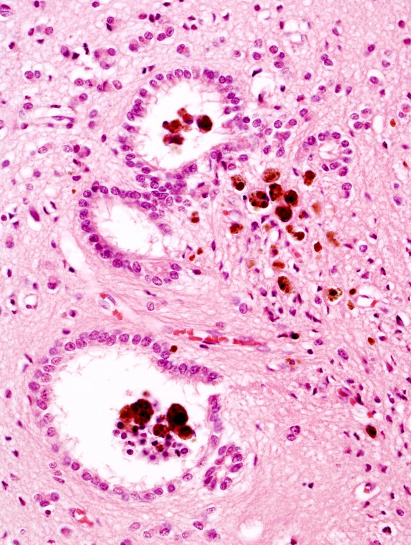 6A4 Aqueductal Gliosis (Case 6) 1 hemorrhage