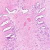 7A2 Aqueductal Gliosis (Case 7) 10X