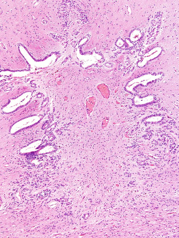 7A2 Aqueductal Gliosis (Case 7) 10X