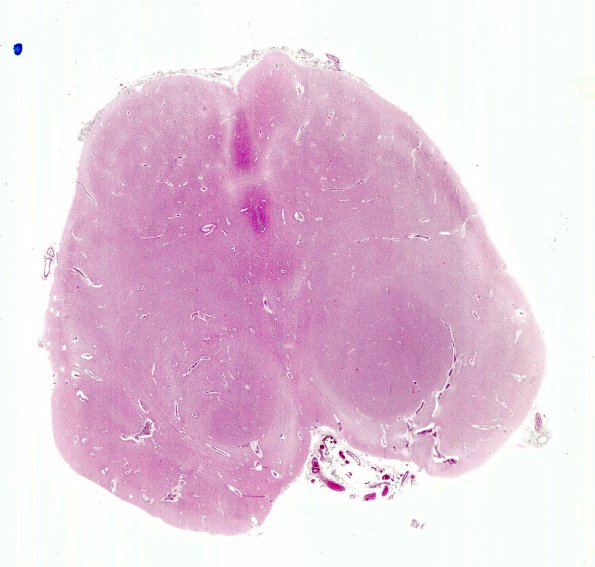 8A1 Aqueductal Atresia (Case 8) H&E whole mount