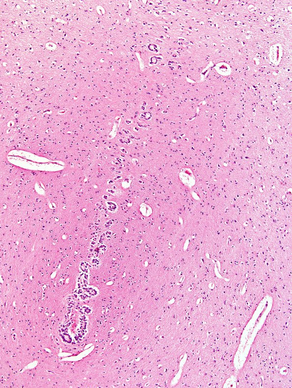 8A2 Aqueductal Atresia (Case 8) 10X