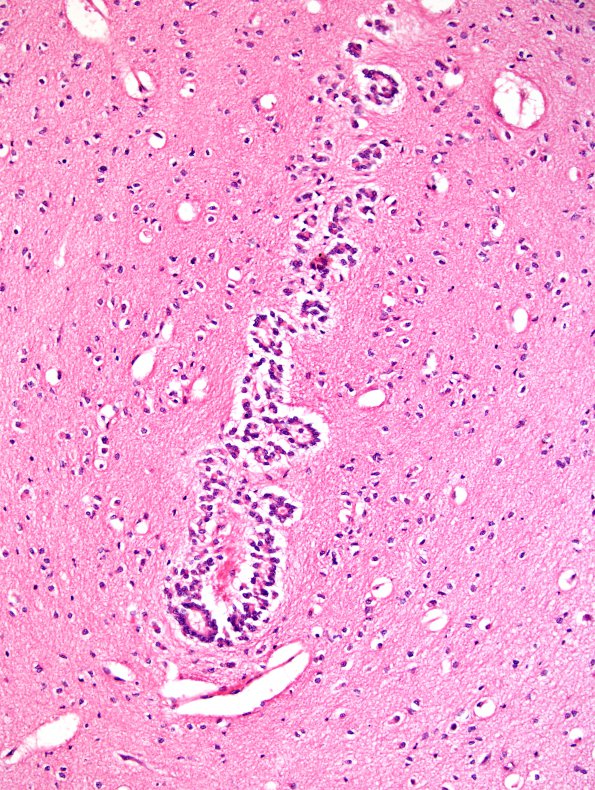 8A3 Aqueductal Atresia (Case 8) 20X