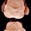 9A1 Hydrocephalus, pontine septum and Hydromyelia (Case 9) 1