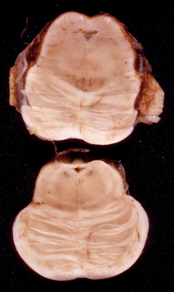 9A1 Hydrocephalus, pontine septum and Hydromyelia (Case 9) 1