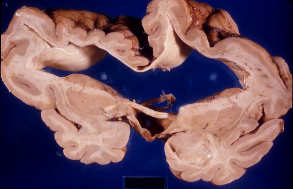 9A3 Hydrocephalus, pontine septum + Hydromyelia (Case 9) 4