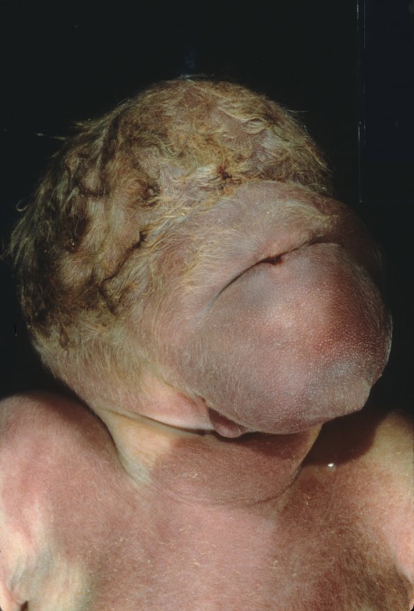 1A1 Aprosencephaly-Atelencephaly spectrum (Case 1) 1