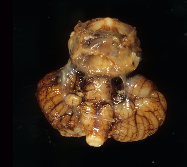 1A3 Aprosencephaly-Atelencephaly spectrum (Case 1) 3