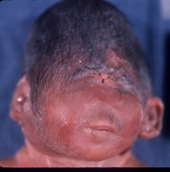 2A1 Aprosencephaly-Atelencephaly-Holoprosencephaly spectrum (Case 2) 1