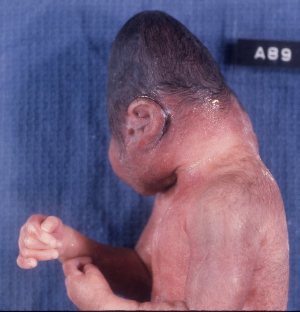 2A2 Aprosencephaly-Atelencephaly-Holoprosencephaly spectrum (Case 2) 2