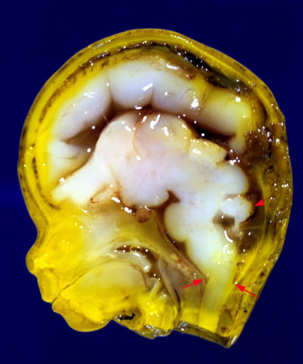 1A1 Brain, normal, fetus (12 wks) 2