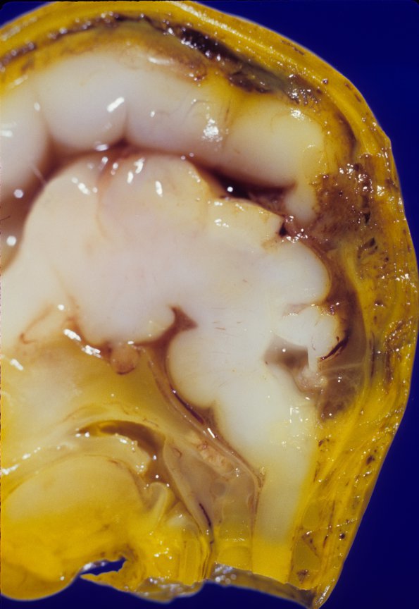 1A2 Brain, fetus, human, normal,  posterior fossa (10-12 weeks) 1