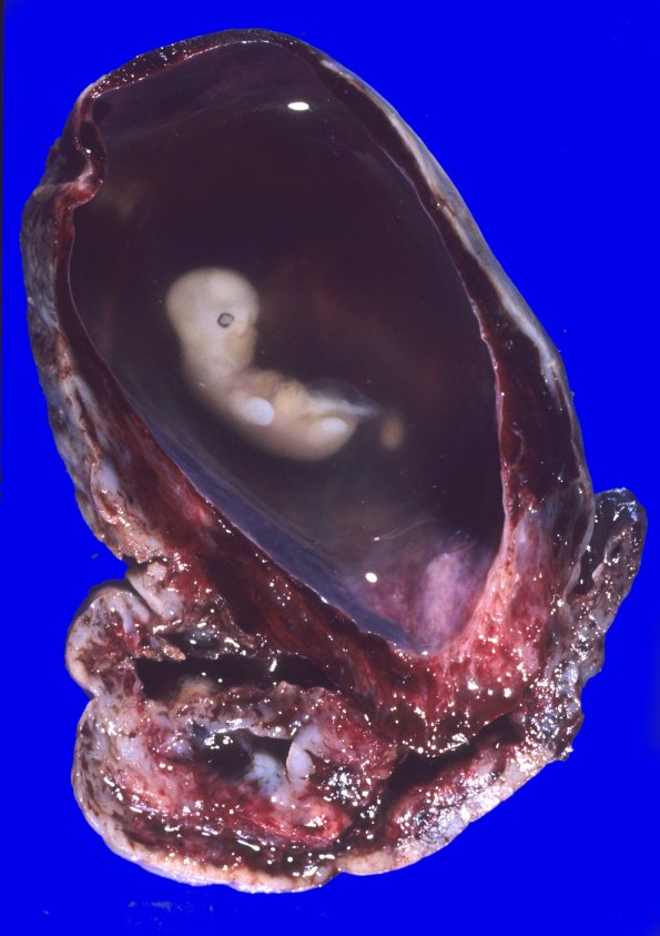 1A Embryo (ectopic pregnancy, approximately 7-8 weeks of gestation) gross 1A