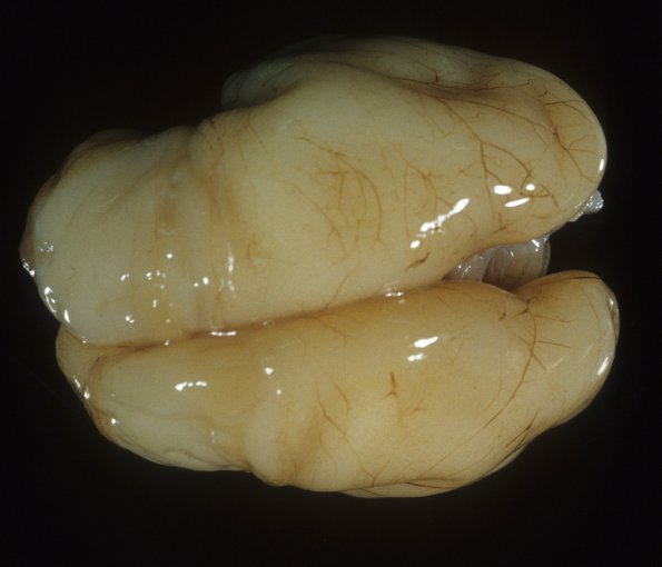 11A2 Normal Fetal Brain 22 wk (Case !!) 2