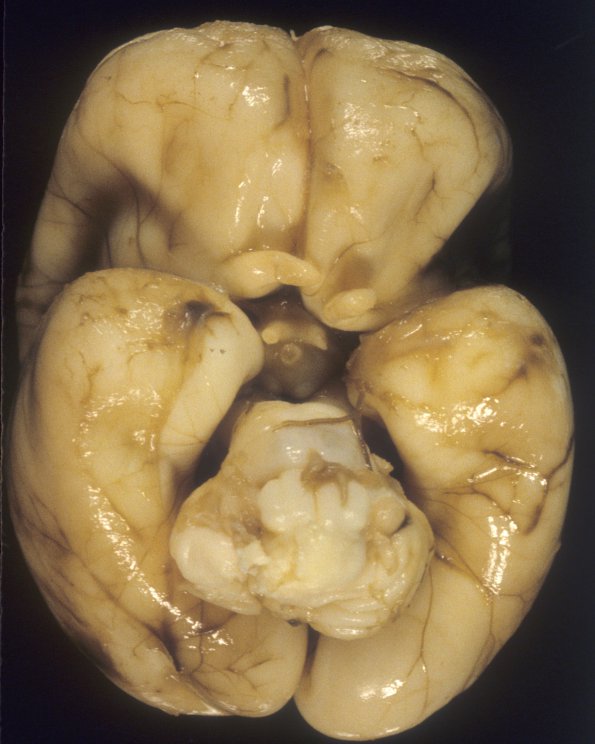 12A1 Normal Fetal Brain 22 wks (Case 12) 1