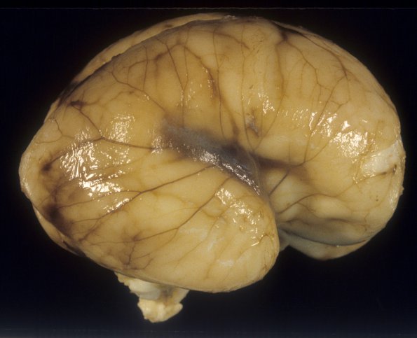 12A2 Normal Fetal Brain 22 wks (Case 12) 2