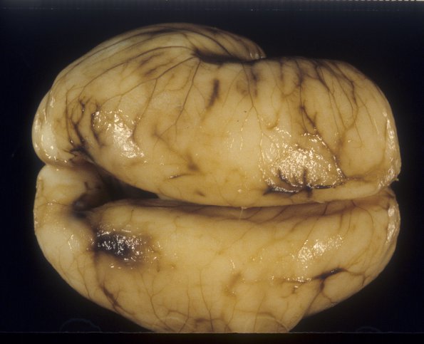 12A3 Normal Fetal Brain 22 wks (Case 12) 3