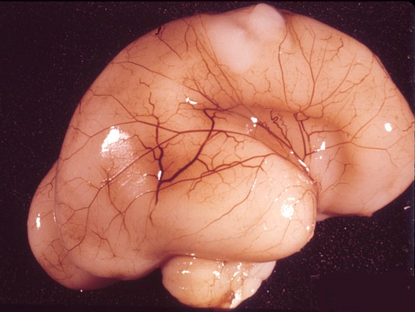 13 Brain, gestation, 23 weeks (Case 13)