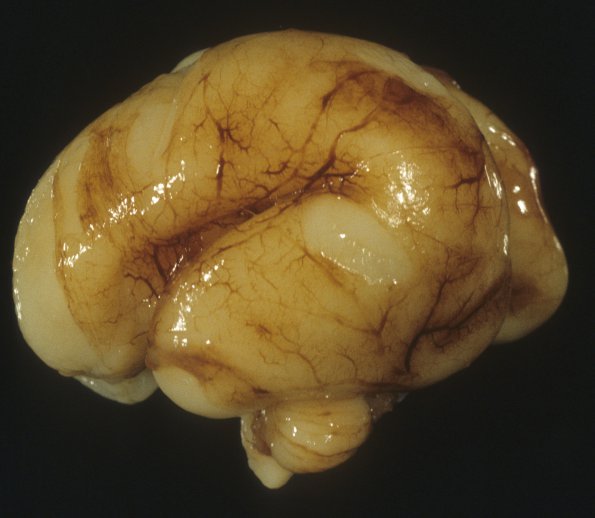 14A1 Normal Fetal Brain, 23wk (Case 14) 1