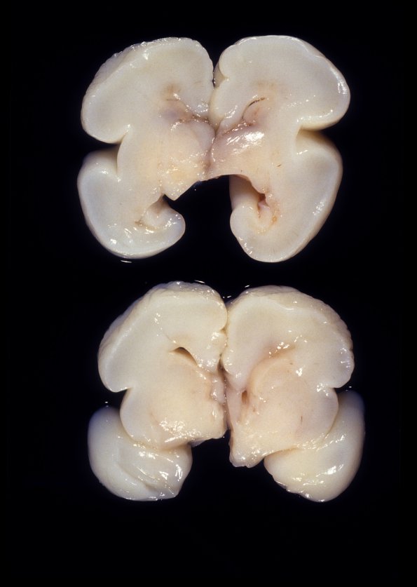 16A1 Normal Fetal Brain 24 wk (Case 16)