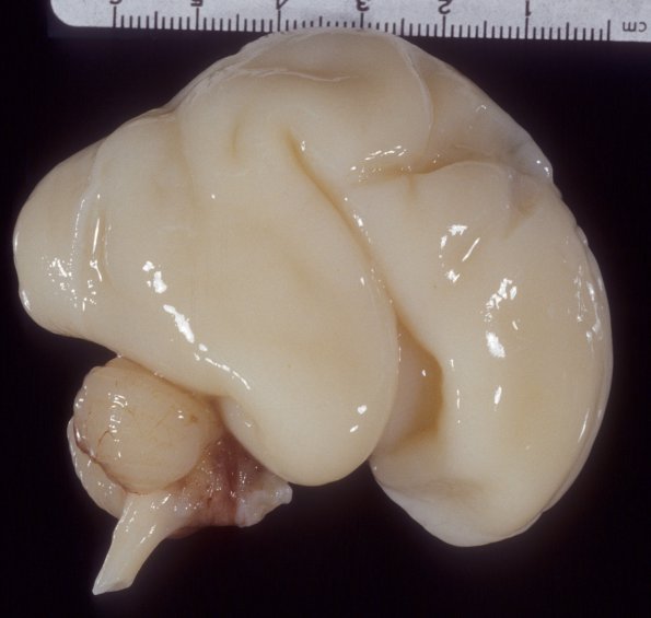 18A1 Normal Fetal Brain 25 wk (Case 18) 1