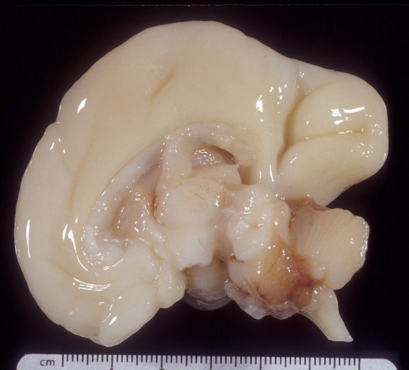 18A2 Normal Fetal Brain 25 wk (Case 18) 2