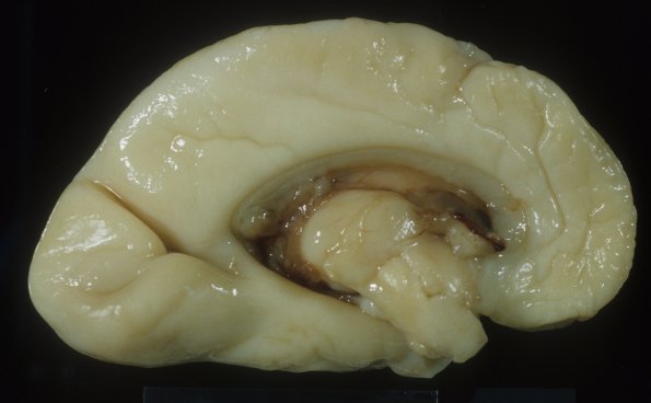 19A1 Normal Fetal Brain 25wk (Case 19) 1