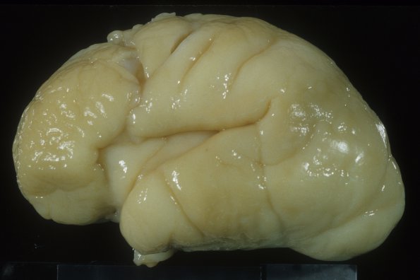 19A2 Normal Fetal Brain 25wk (Case 19) 2