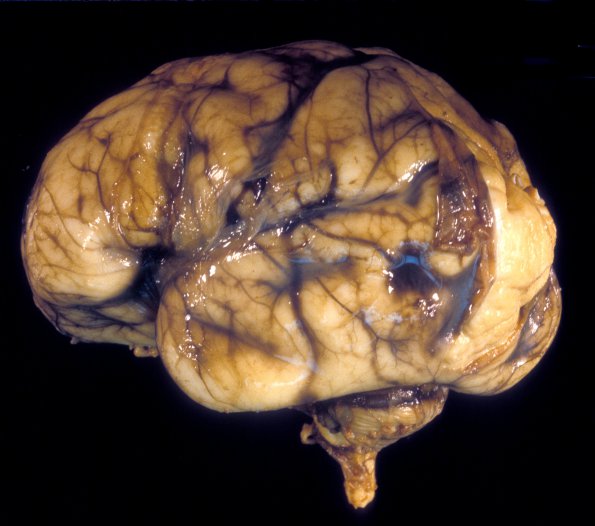 20A1 Normal Fetal Brain 27 wk (Case 20) 1