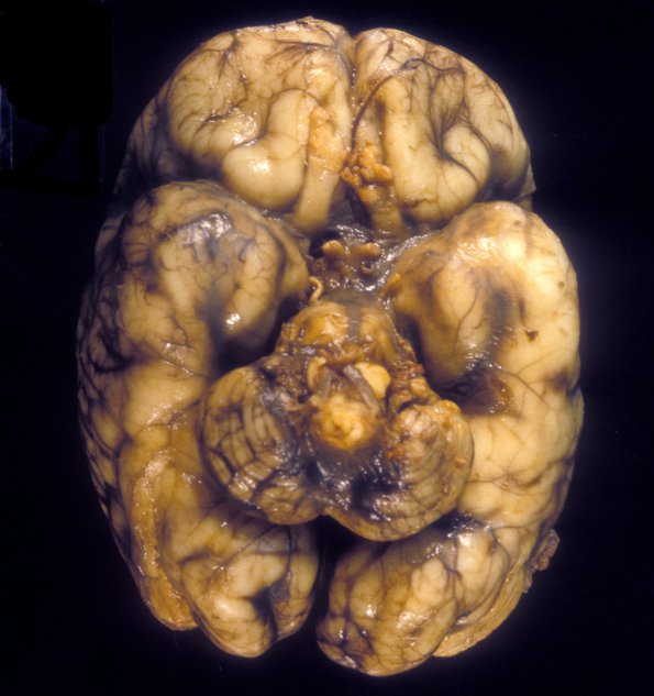 20A2 Normal Fetal Brain 27 wk (Case 20) 12