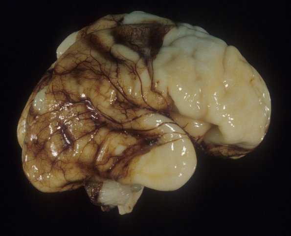 21A1 Normal Fetal Brain 27 wk (Case 21) 1