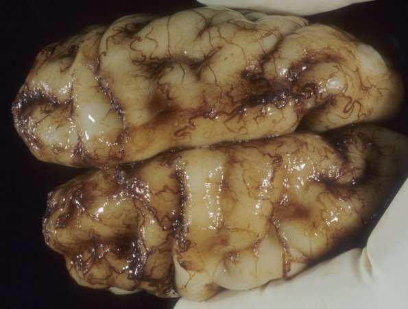 22A2 Normal Fetal Brain 28 wk (Case 22) 2