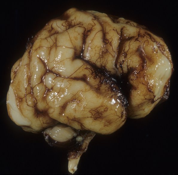 22A3 Normal Fetal Brain 28 wk (Case 22) 3