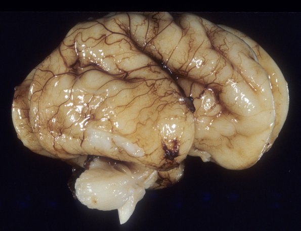 23 Normal Fetal Brain 28 wk (Case 23)