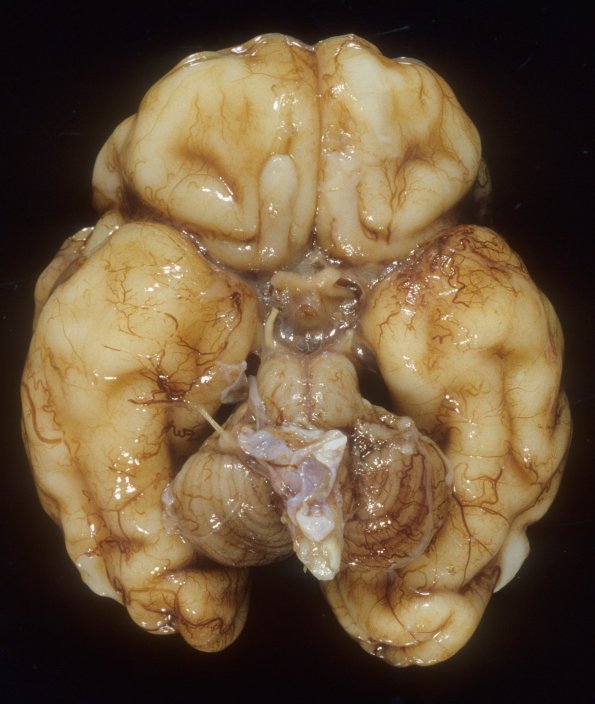 24A1 Normal Fetal Brain 31 wk (Case 24) 1