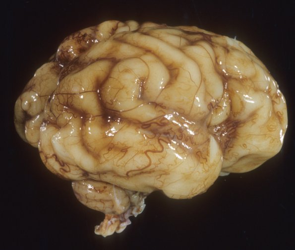 25A1 Normal Fetal Brain 31 wk (Case 25) 2