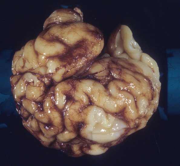 26A1 Normal Fetal Brain 31 wk (Case 26) 1