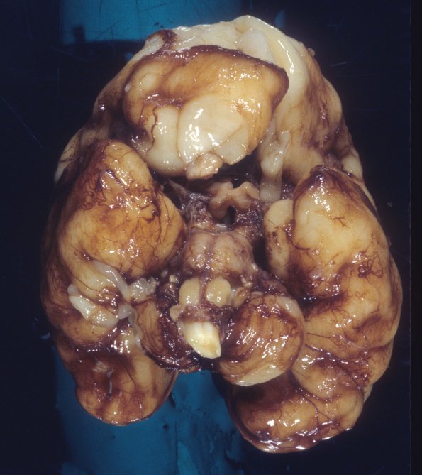 26A2 Normal Fetal Brain 31 wk (Case 26) 2