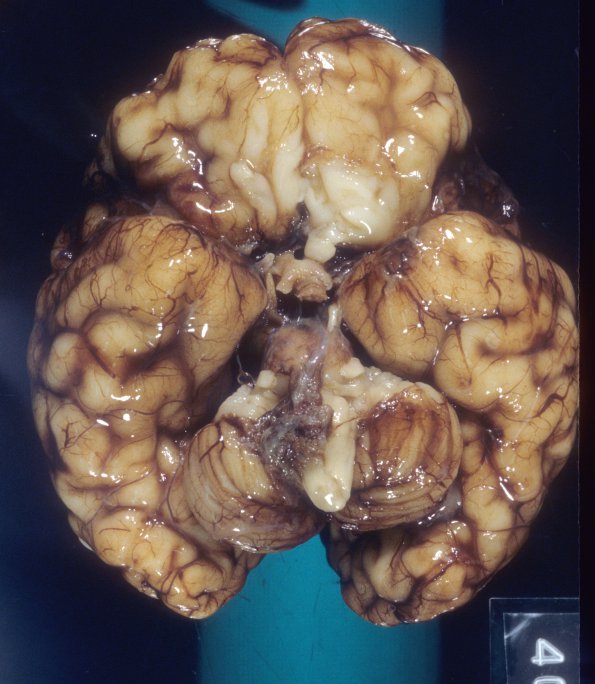 27A1 Normal Fetal Brain 35 wk (Case 27) 3