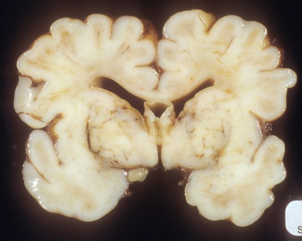 27A2 Normal Fetal Brain 35 wk (Case 27) 2