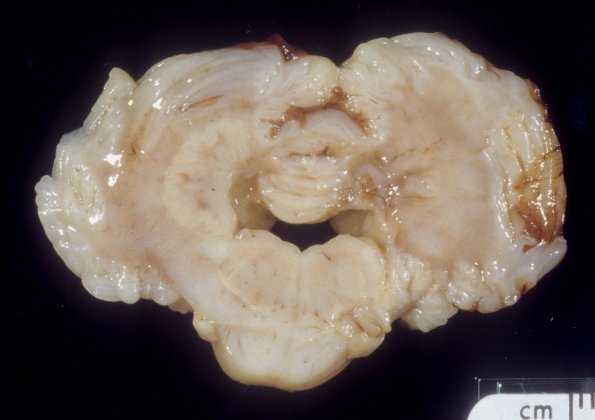 35C weeks, Normal Fetal Brain 35 wk (A40492) 1