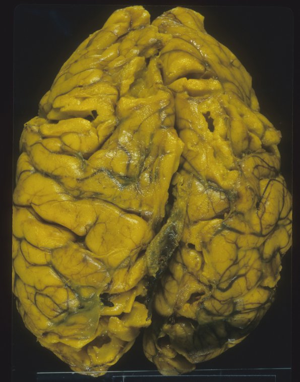 28A1 Normal Fetal Brain, 36wk (Case 28) 1