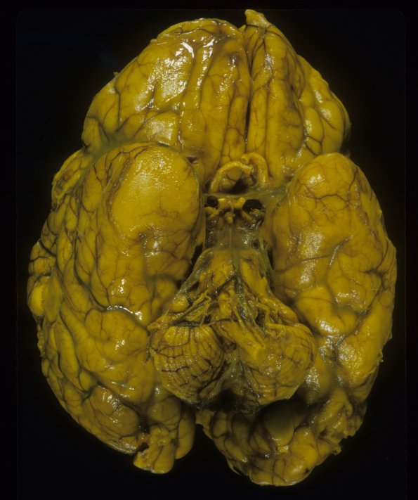 28A2 Normal Fetal Brain, 36wk (Case 28) 2