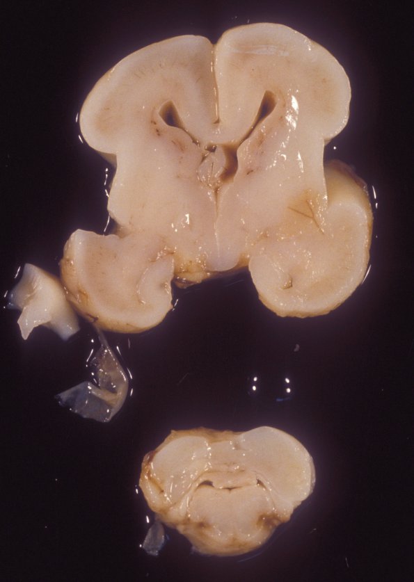 3 Normal Fetal Brain 20 weeks (Case 3)