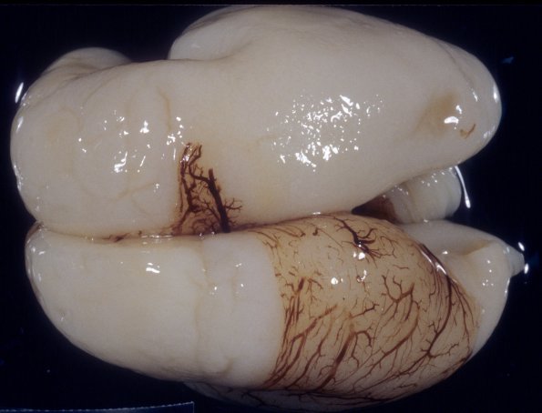 4A1 Normal Fetal Brain 20 wks (Case 4) 3