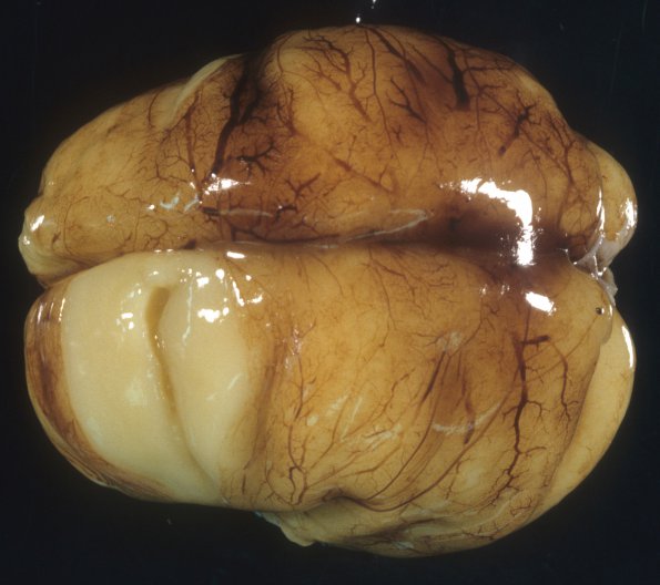 5A1 Normal Fetal Brain 21 wk (Case 5) 1