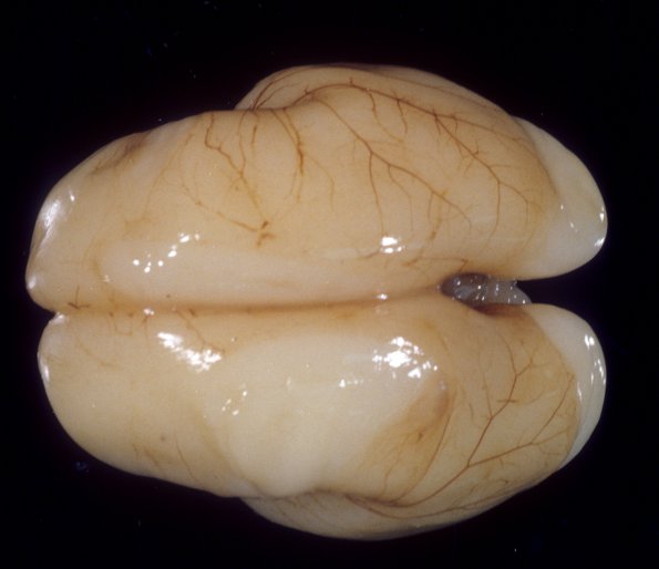 6A2 Normal Fetal Brain 21 wk (Case 6) Twin A 2