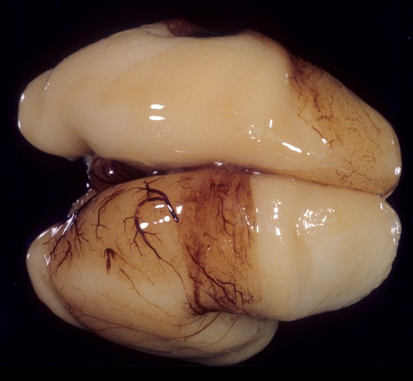 7A1 Normal Fetal Brain 21 wk (Case 7) Twin B 1