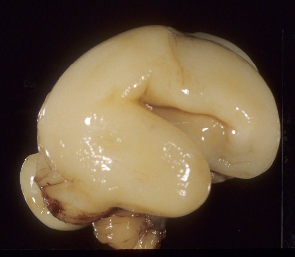 8 Normal Fetal Brain 21 wk (Case 8) 1