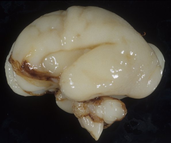 9A1 Normal Fetal Brain 21 wk (Case 9) 1